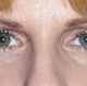 bleph-ptosis-repairafter.jpg