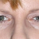 bleph-ptosis-repairbefore.jpg