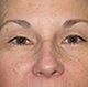 blepharoplasty-before.jpg