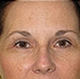 blepharoplasty-after.jpg