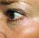 Botox-crows-feet-after.jpg