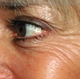 Botox-crows-feet1.jpg