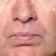 restylaneBA-afterman.jpg