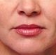 restylaneBA-beforewoman.jpg