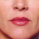 restylaneBA-afterwoman.jpg